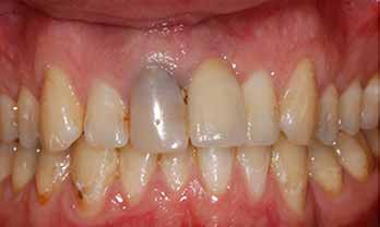 Dental implants portishead - Before Treatment