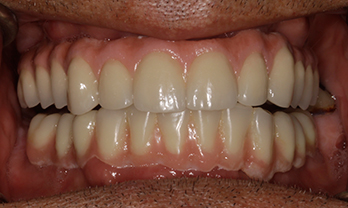 Dental implants portishead - after Treatment