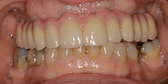 Dental implants portishead - after Treatment