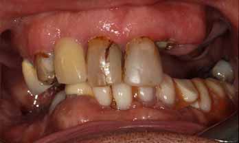 Before Treatment - Teeth Whitening Portishead