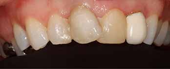 Dental Crowns Portishead - Before Treatment