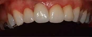 Dental veneers Portishead - After Treatment